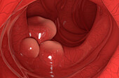 Colon cancer, illustration