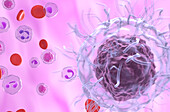 Hairy cell leukaemia, illustration