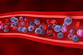 Acute myeloid leukemia, illustration