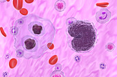 Lymphoma cells, illustration
