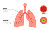 Bronchitis and bronchiolitis, illustration