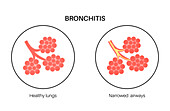 Bronchitis lung disease, illustration