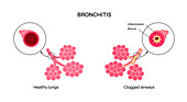 Bronchitis lung disease, illustration