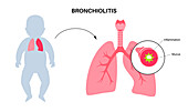 Bronchiolitis lung disease, illustration