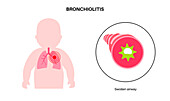 Bronchiolitis lung disease, illustration