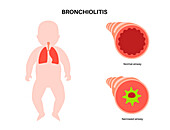 Bronchiolitis lung disease, illustration