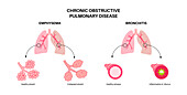 Chronic obstructive pulmonary disease, illustration