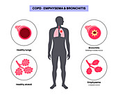 Chronic obstructive pulmonary disease, illustration