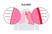 Pleurisy, illustration