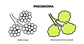 Pneumonia, illustration