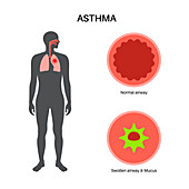 Asthma, illustration