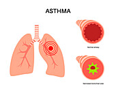 Asthma, illustration