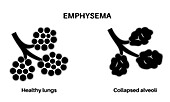 Emphysema, illustration