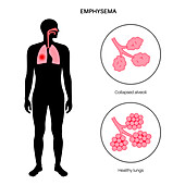 Emphysema, illustration