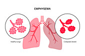 Emphysema, illustration