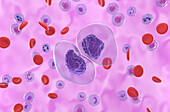 Prolymphocytic leukaemia, illustration