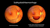 Subhyaloid haemorrhage on the retina, illustration