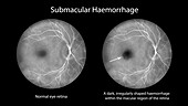 Submacular haemorrhage on the retina, illustration