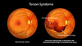 Intraocular haemorrhage in Terson syndrome, illustration