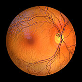 Prepapillary vascular loop on the retina, illustration