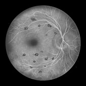 Roth spots in the retina, illustration
