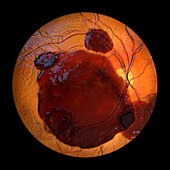 Subretinal haemorrhage, illustration