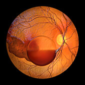 Intraocular haemorrhage in Terson syndrome, illustration