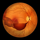 Intraocular haemorrhage in Terson syndrome, illustration