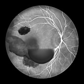 Intraocular haemorrhage in Terson syndrome, illustration