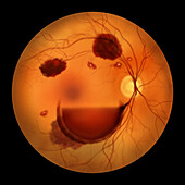 Intraocular haemorrhage in Terson syndrome, illustration