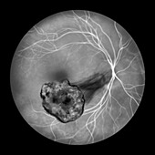 Toxoplasma retinochoroiditis, illustration