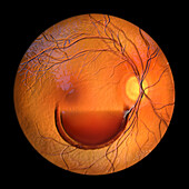 Valsava retinopathy, illustration