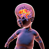 Baby with enlarged lateral ventricles, illustration