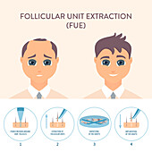 FUE hair transplantation, conceptual illustration