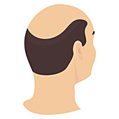 Alopecia in men, conceptual illustration