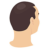 Alopecia in men, conceptual illustration