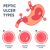 Peptic ulcer, conceptual illustration