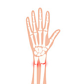 Fractured wrist, illustration
