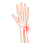 Fractured wrist, illustration