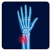 Fractured wrist, illustration