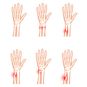 Fractured wrists, illustration