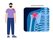 Shoulder pain and arthritis, conceptual illustration