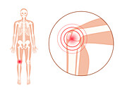 Knee pain, conceptual illustration