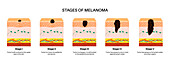 Melanoma stages, illustration
