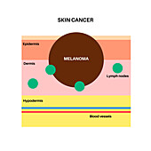 Skin cancer, illustration