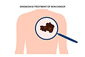 Skin cancer, illustration