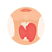 Thyroid gland disorder, conceptual illustration