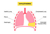 Chylothorax, illustration