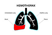 Haemothorax, illustration