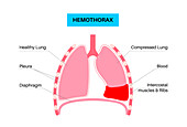 Haemothorax, illustration
